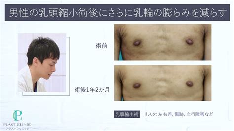 男 乳首 大きい|男性の乳頭縮小手術のメリットやデメリットを美容 .